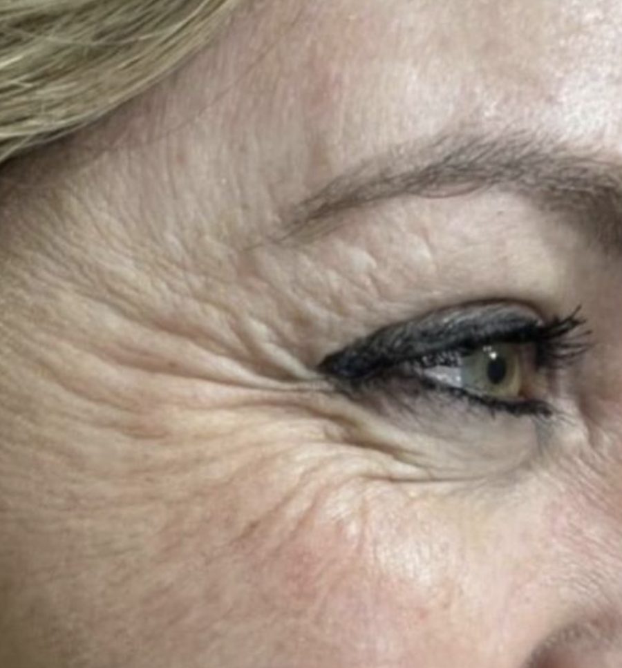 Crow's feet, the fine lines at the corner of the eyes