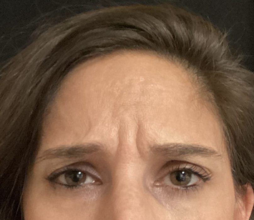 The elevens, the vertical frown lines between the brows