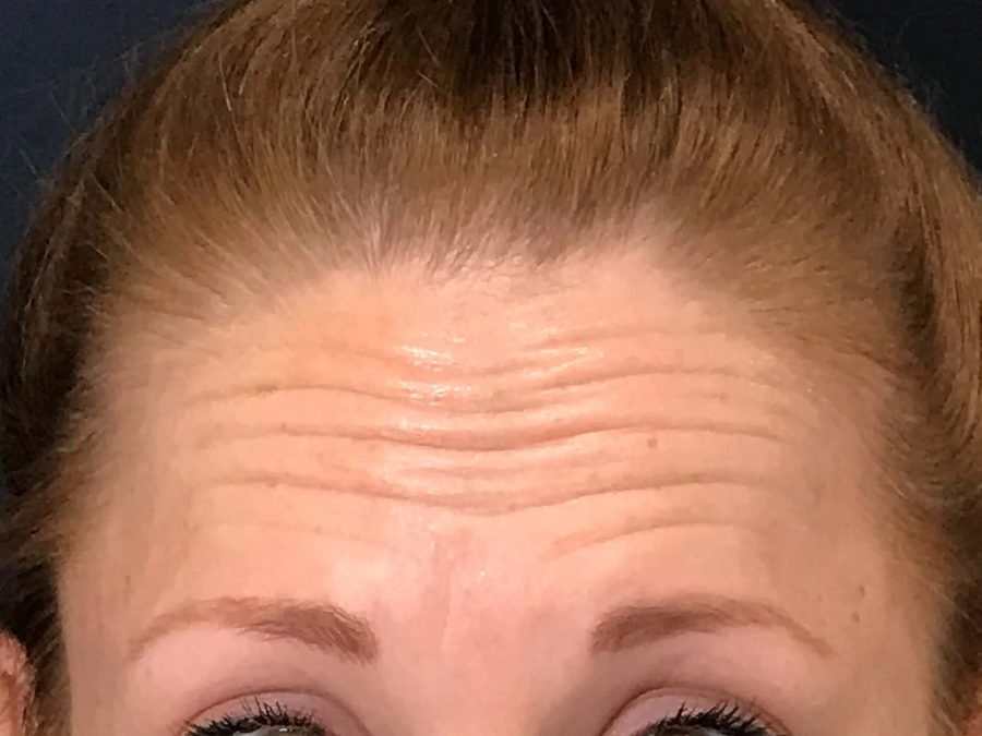 Forehead lines, softened without freezing the brow