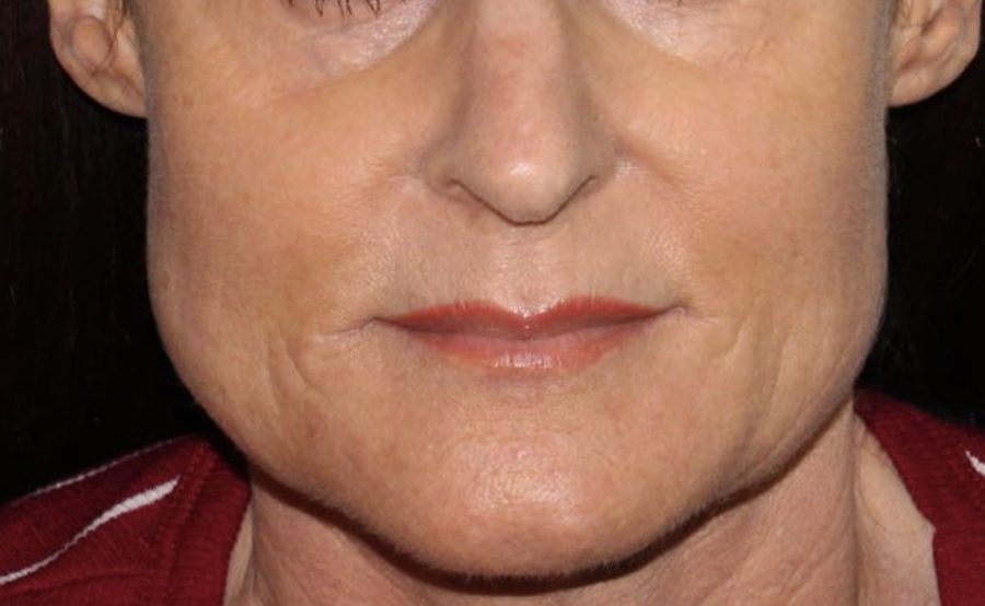 Masseter, for jaw tension and a softer lower-face line